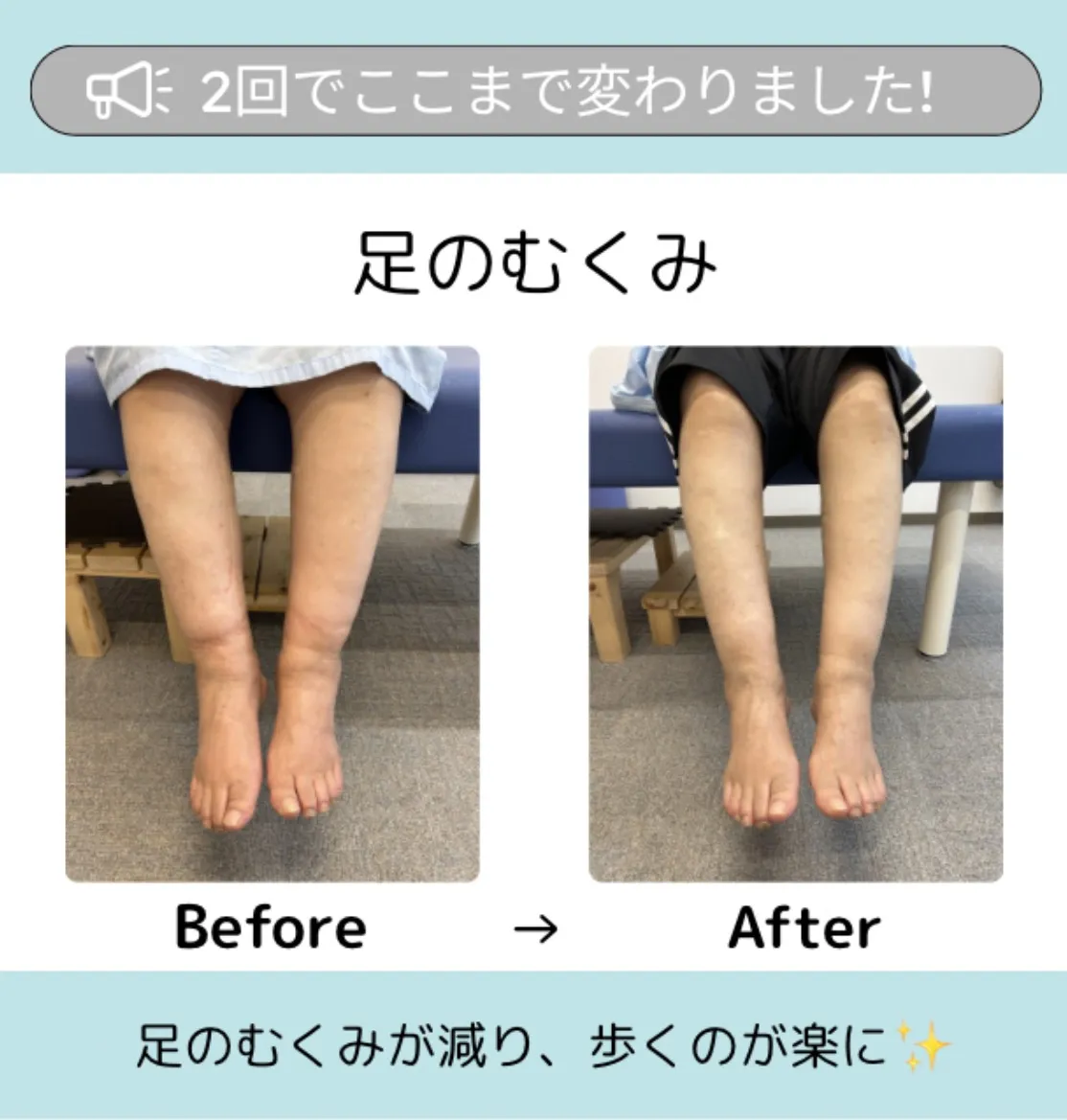足のむくみ